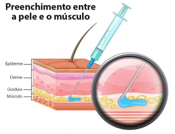 Diagrama da bioestimulação de colágeno na pele