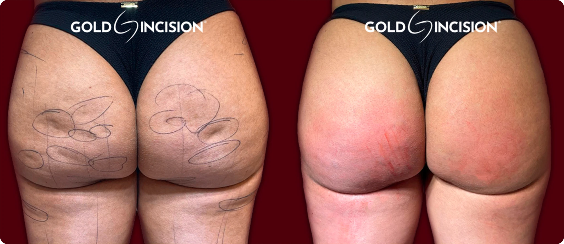 Antes e depois do tratamento de celulite